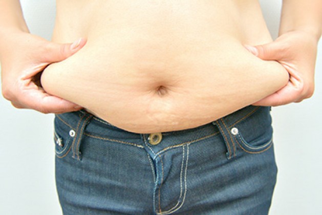 Abdominoplasty